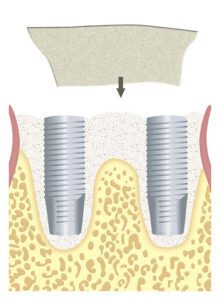 membrana-alveolo-post-estraccion-muela