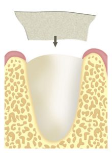 membrana-alveolo-postextraccion