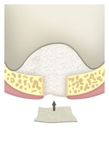 membrana-aumento-seno-maxilar