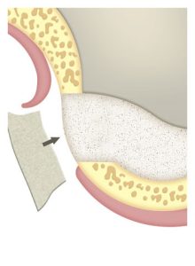 membrana-aumento-seno-maxilar-lateral