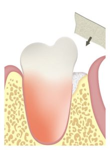 membrana-defecto-infraoseo