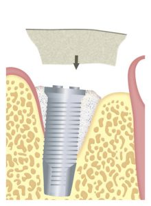 membrana-defecto-periimplantario